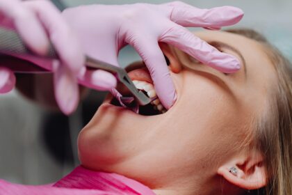 Dental implants